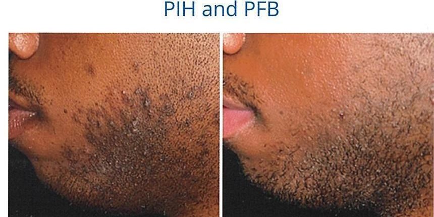 aerolase-1 aerolase pih and pfb before and after
