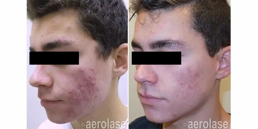 aerolase-2 aerolase acne before and after