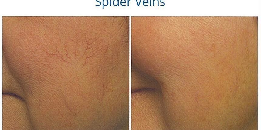 aerolase-3 aerolase spider veins before and after