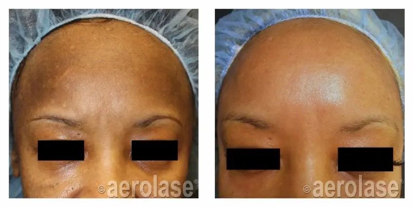 aerolase-4 aerolase forehead before and after