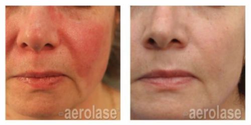 aerolase-5 aerolase before and after