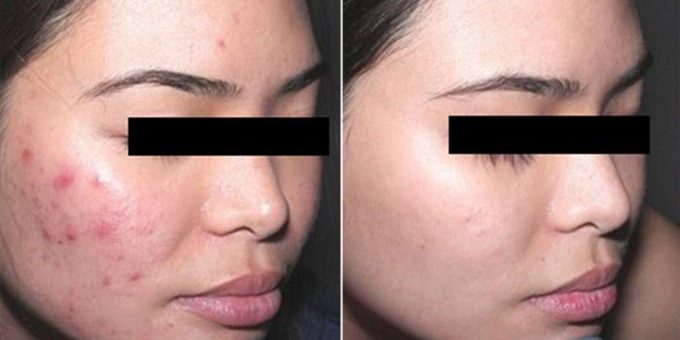 aerolase-6 before and after aerolase