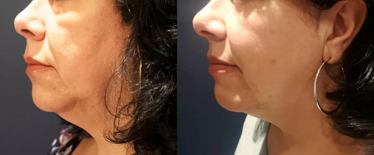 Morpheus8, jowling treatment