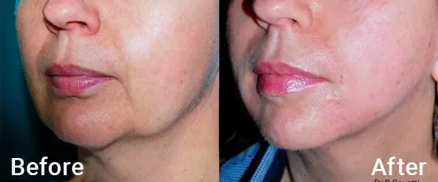 Morpheus8, jowling and marionette lines treated