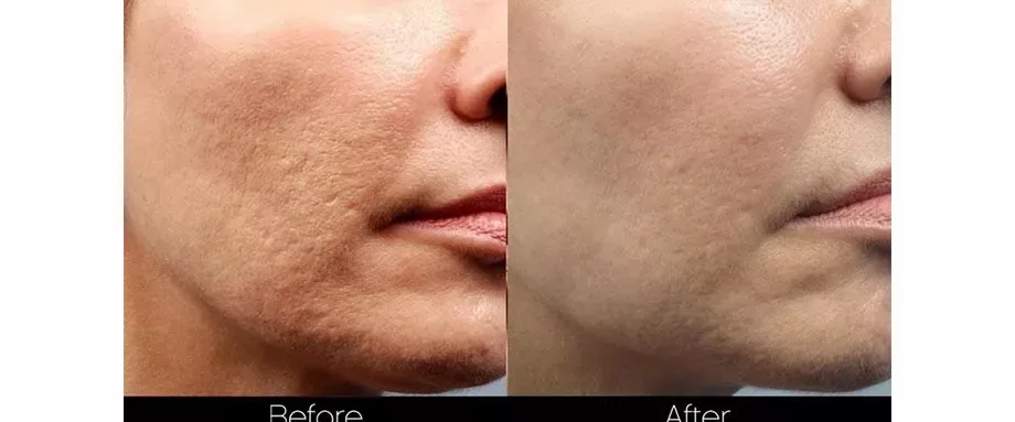 Morpheus8, acne scarring on cheek treated