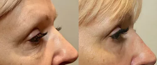 Morpheus8, nasolabial fold treated