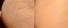 Morpheus8, cellulite on butt treated