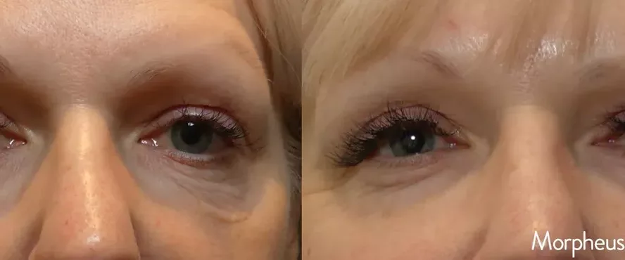 Morpheus8 before and after