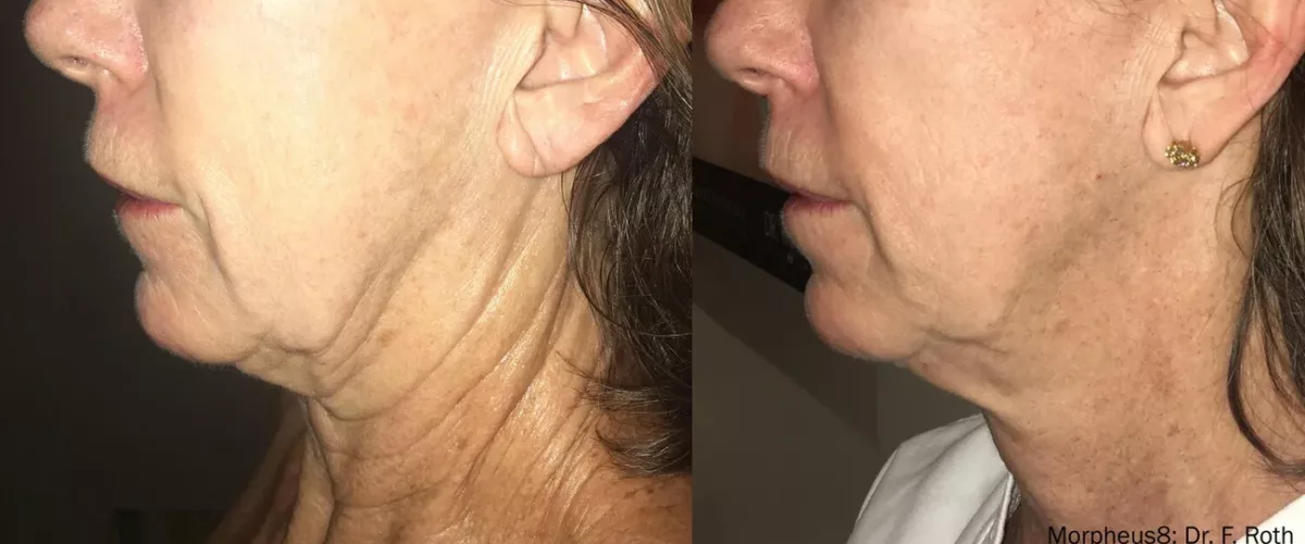Morpheus8, turkey neck treated