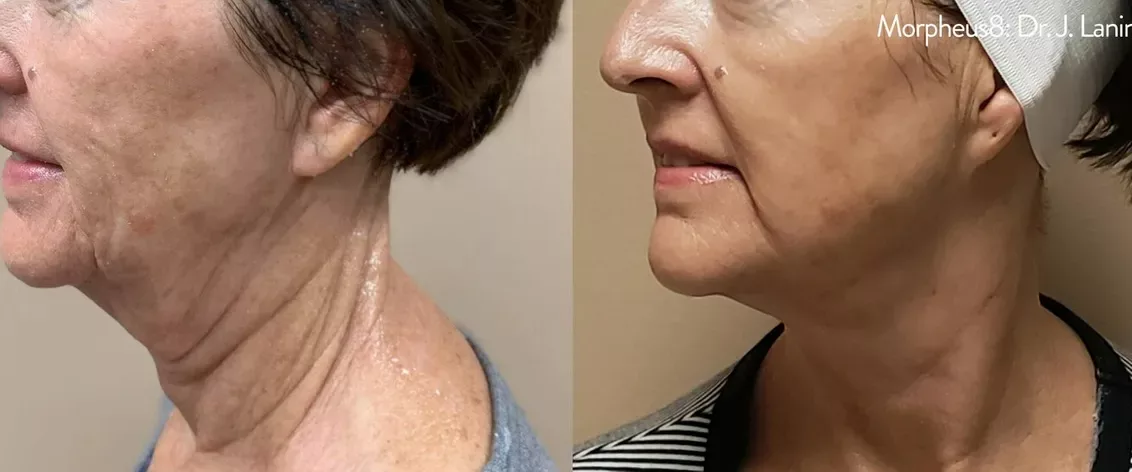 Before and After RSL #5