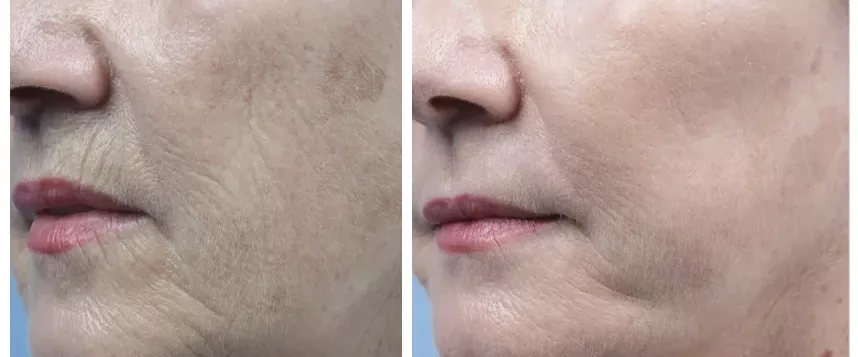 Before and after Morpheus8