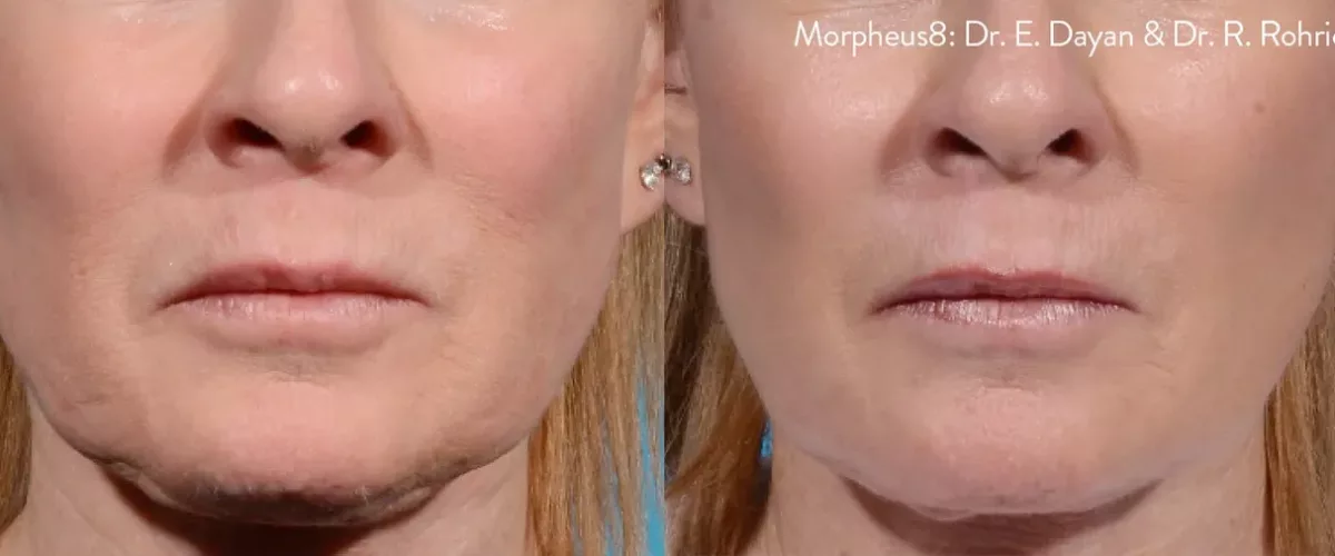 Before and after Morpheus8