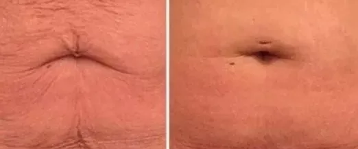 body sculpting and remodeling