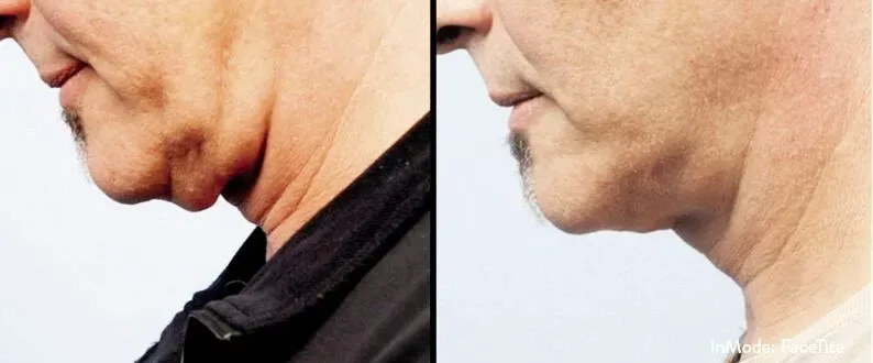 Morpheus8, double chin treatment