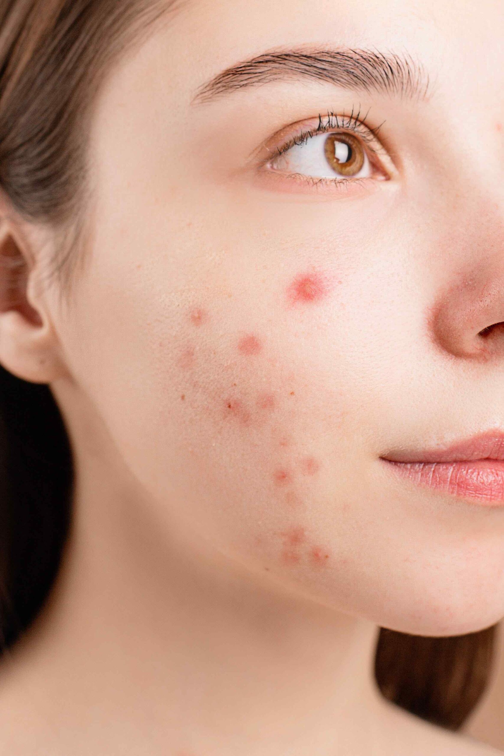 girl with moderate acne on her right cheek