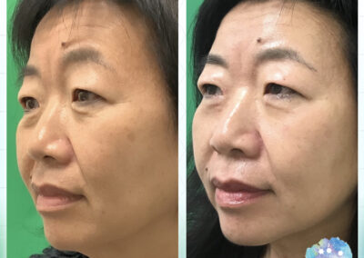 Rejuvenation Skin Lab - Morpheus8 Before & After