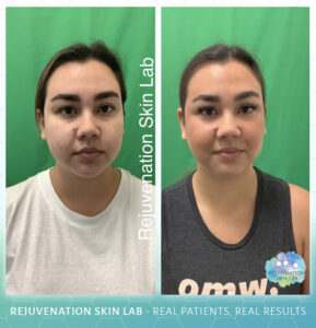 Rejuvenation Skin Lab - Morpheus8 Before & After