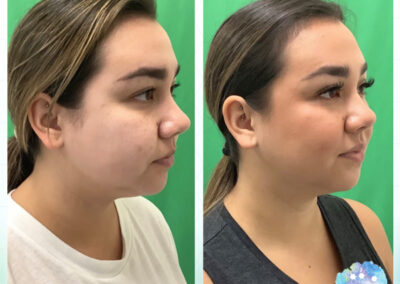 Rejuvenation Skin Lab - Morpheus8 Before & After