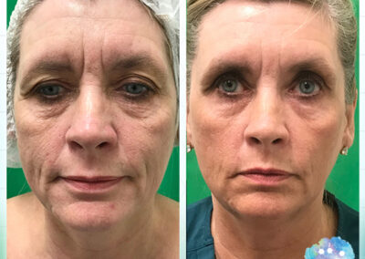 Rejuvenation Skin Lab - Morpheus8 Before & After