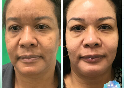 Rejuvenation Skin Lab - Before & After