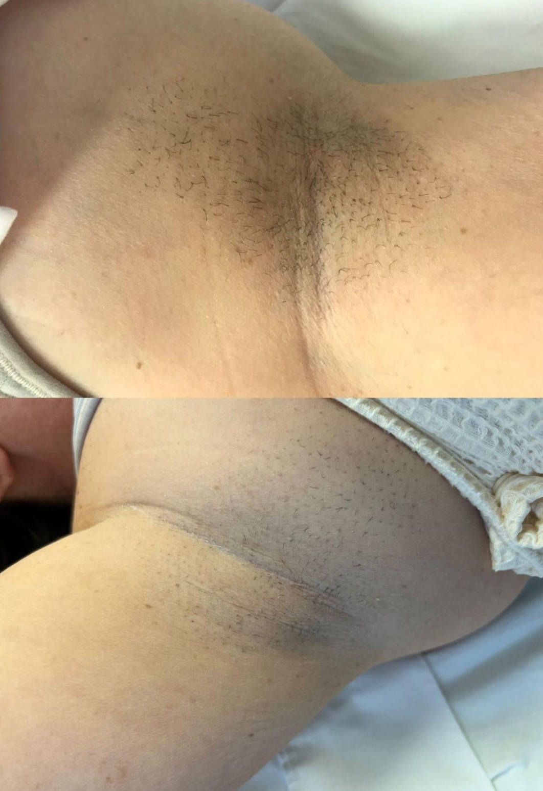 RSL - Underarms B&A
