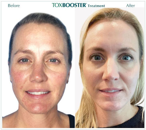botox