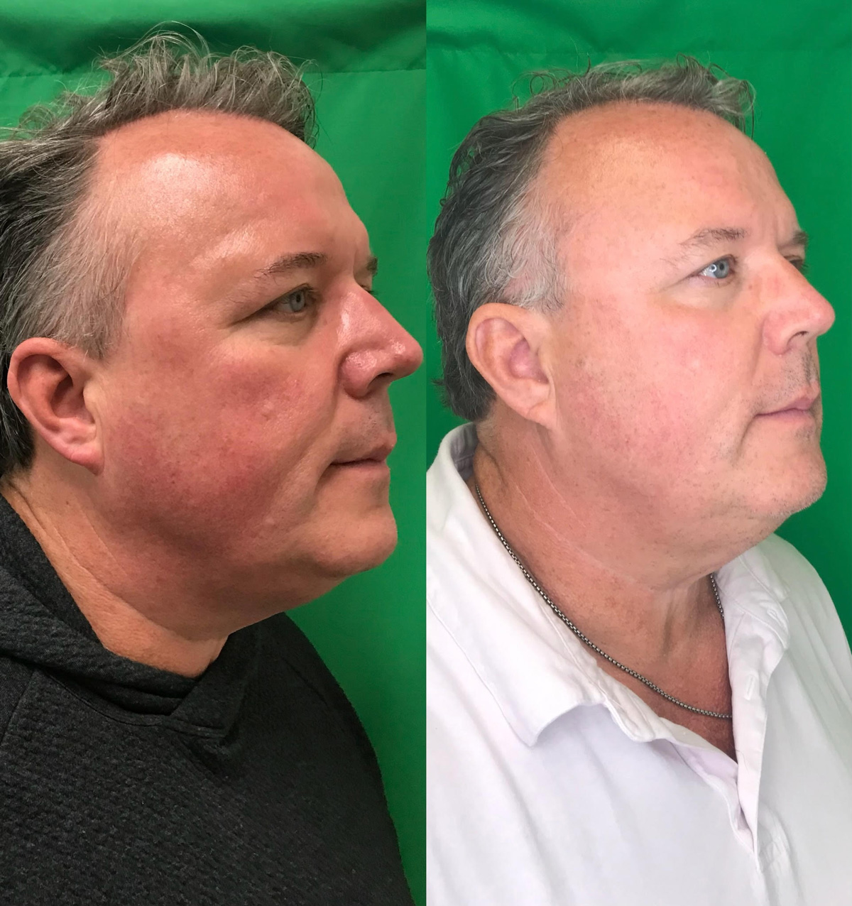 Side-by-side images of before and after exosome treatment on a patient’s face.