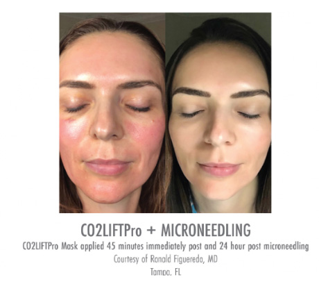 Side-by-side images of before and after C02 lift pro treatment on a patient’s face.