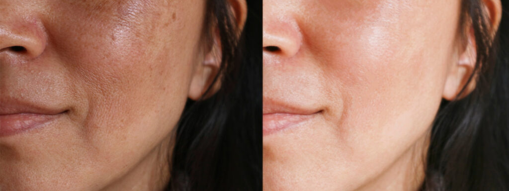 Melasma Treatment in Richmond