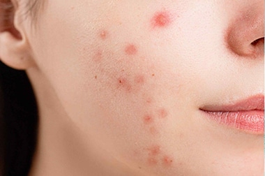 Rejuvenation Skin Lab - Acne Treatments