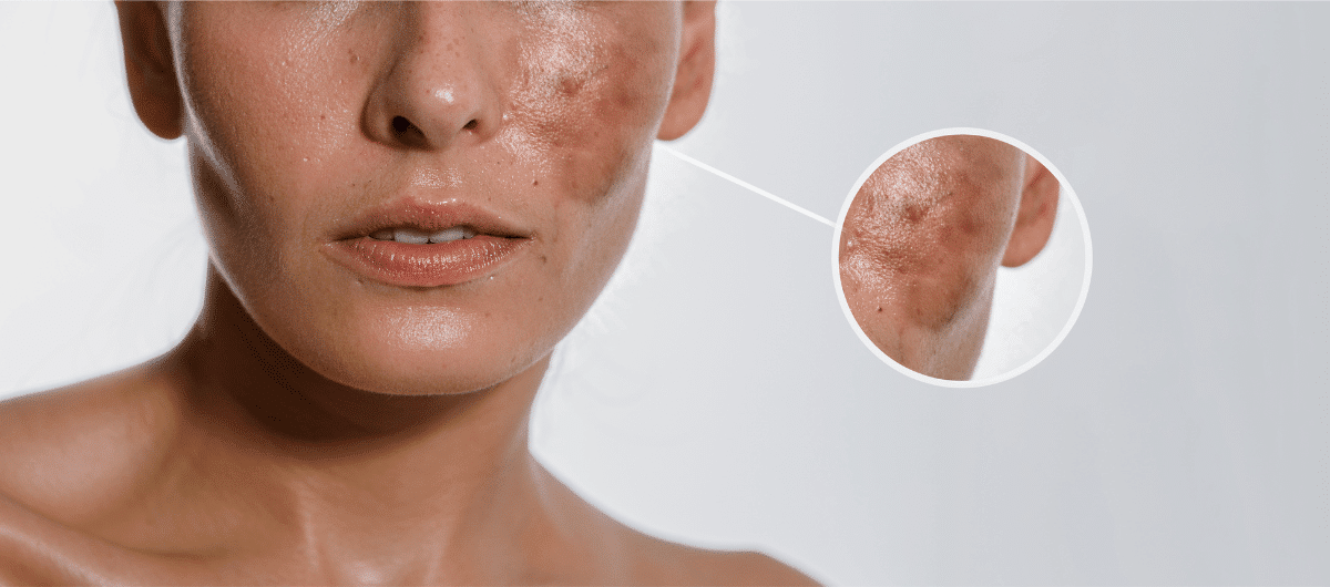A woman with hyperpigmentation