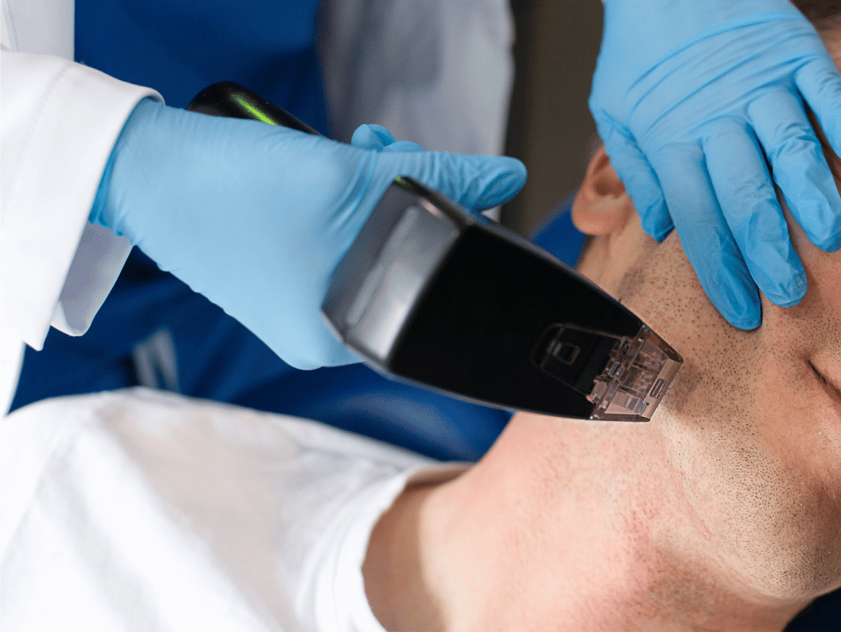 A man receiving Morpheus8 skin treatment